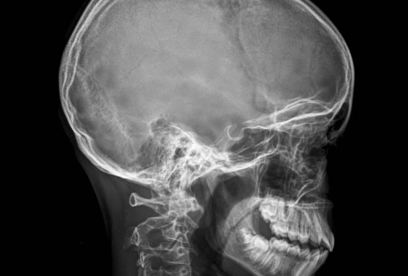 Cranioplasty Explained: When & Why Skull Reconstruction Is Needed