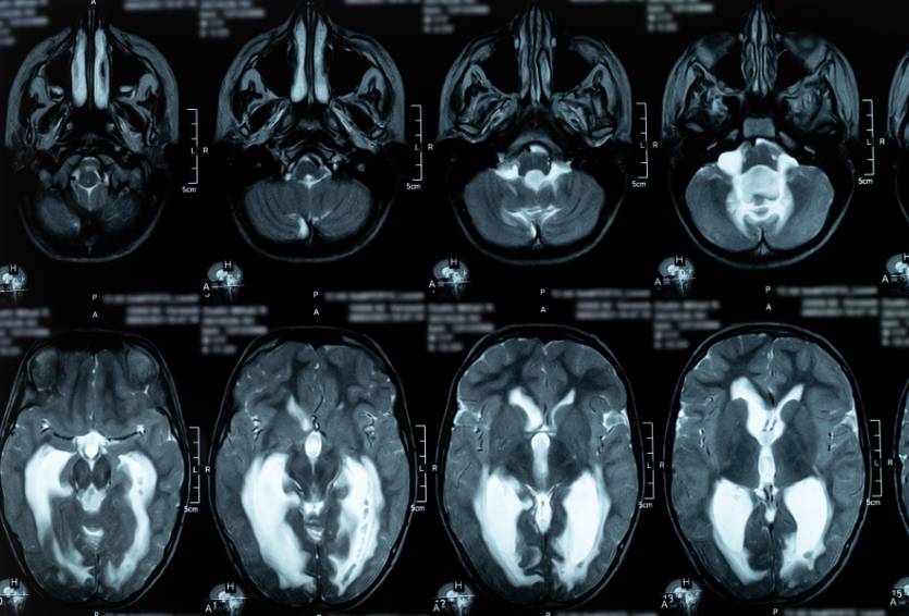 Hydrocephalus in Adults: Symptoms, Causes, and Treatment Options
