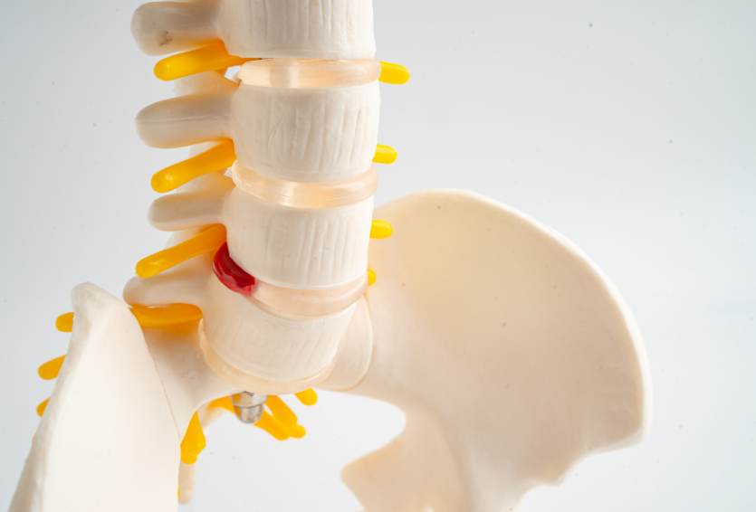 Lumbar Disc Herniation: When to Consider Surgery vs. Physical Therapy