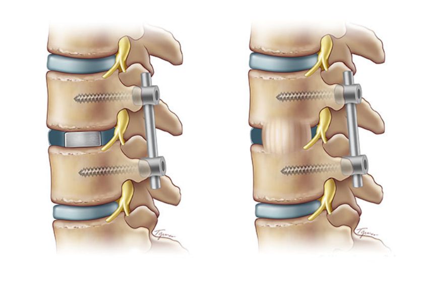 Comparison of Anterior vs. Posterior Minimally Invasive Fusion Surgery for Lumbar Degenerative Disc Disease
