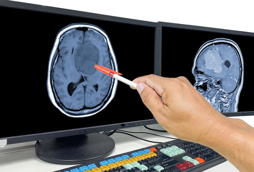 The Role of Chemotherapy in Glioblastoma Multiforme