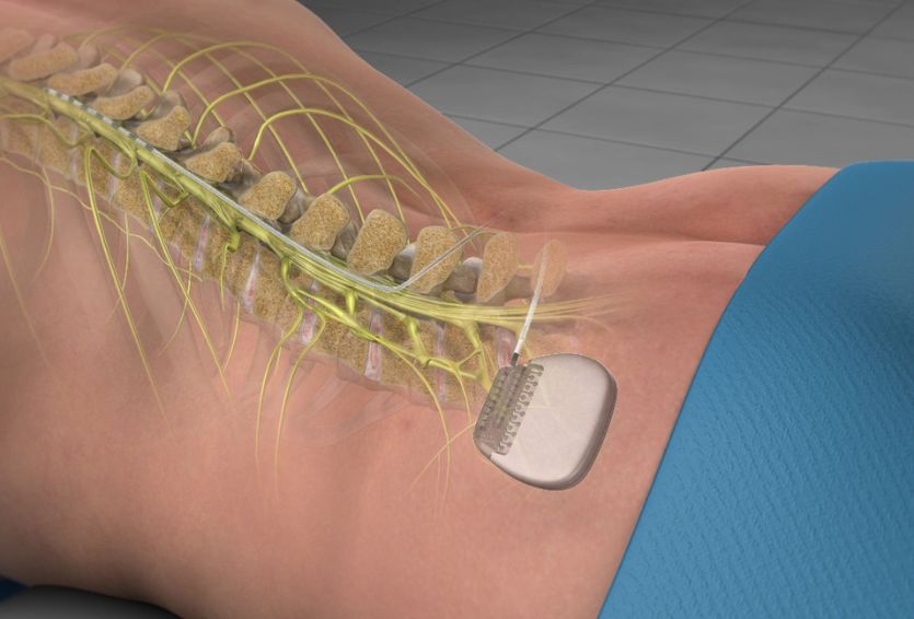 The Role of Spinal Cord Stimulation in Multidisciplinary Pain Management