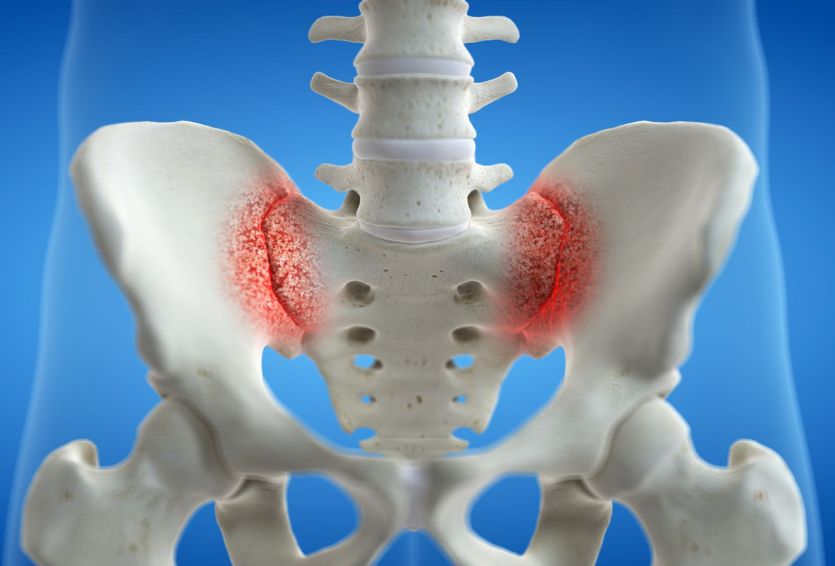 Sacroiliac Joint Dysfunction: When to Consider SI Joint Fusion Surgery