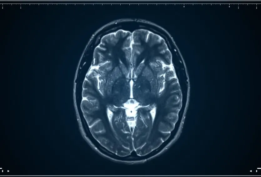 Treating Chiari Malformation: When Is Decompression Surgery Necessary?