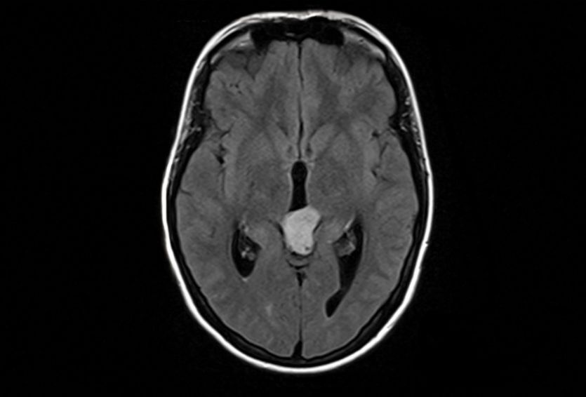 Understanding Pineal Gland Tumors: Symptoms, Diagnosis, and Surgery Options