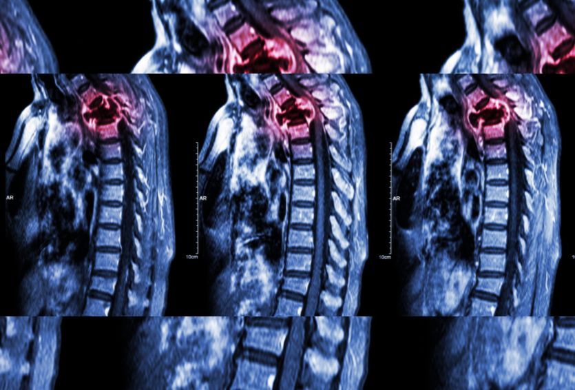 Thoracic Spine Surgery: When Mid-Back Pain Requires a Surgical Solution