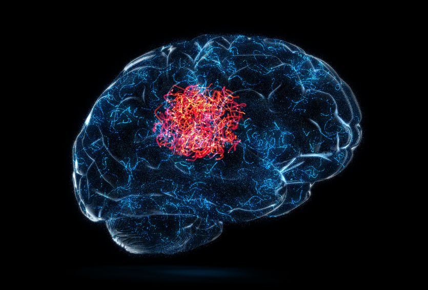 Brain Tumor Biopsy vs. Resection: Understanding the Best Approach for Treatment