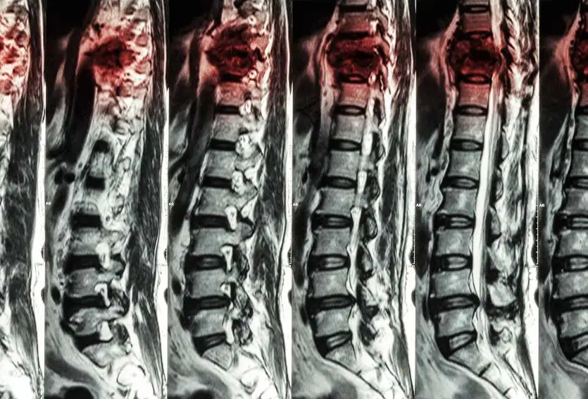 The Role of Kyphoplasty in Treating Spinal Compression Fractures in Osteoporotic Patients