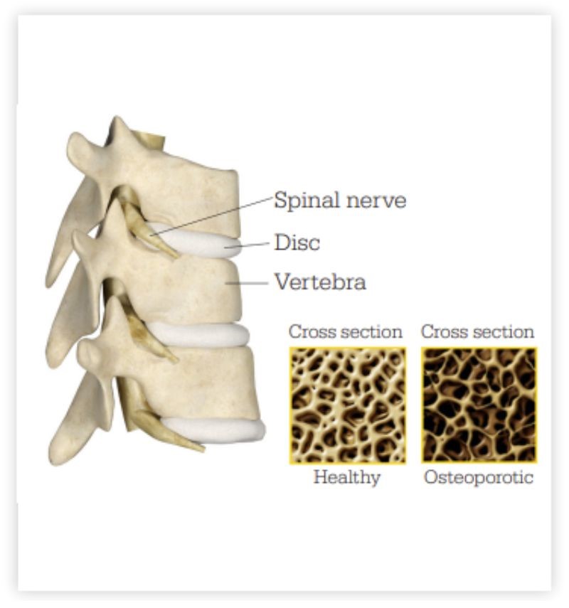 Healthy vs. osteoportoic vertebra