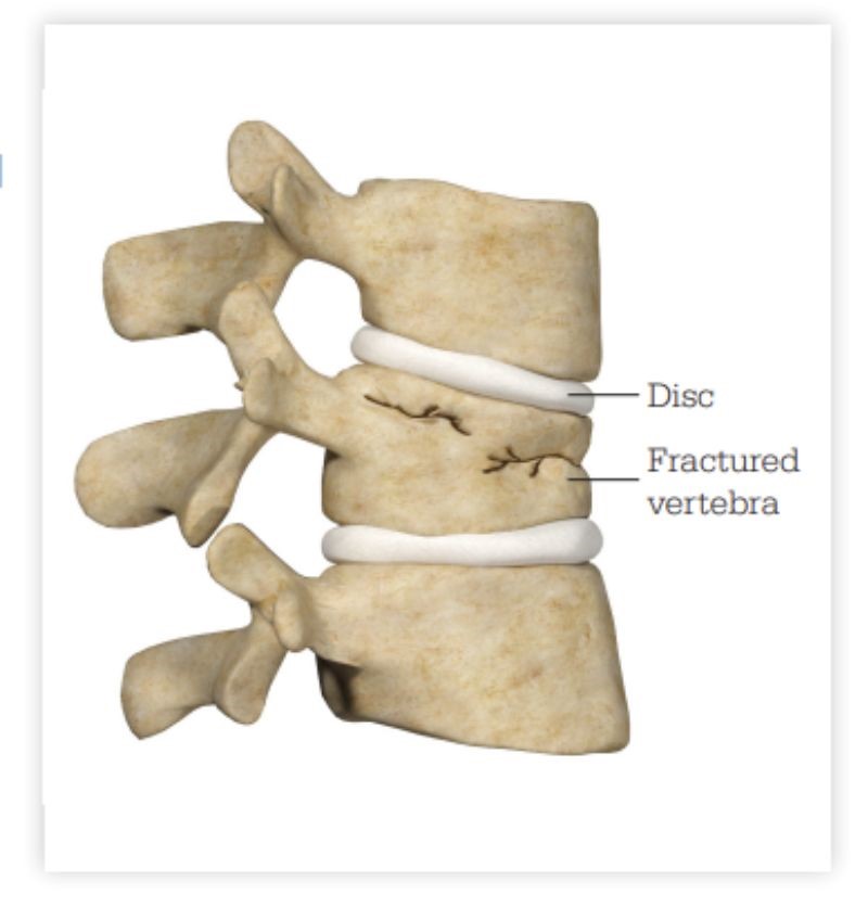 Spinal Trauma