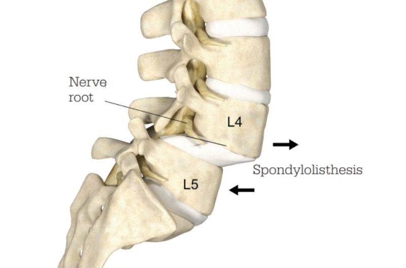 Spondylolisthesis at IGEA Brain, Spine, Pain & Orthopedics in NJ & NY.