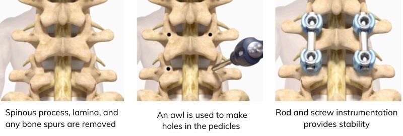 THORACOLUMBAR LAMINECTOMY AND FUSION
